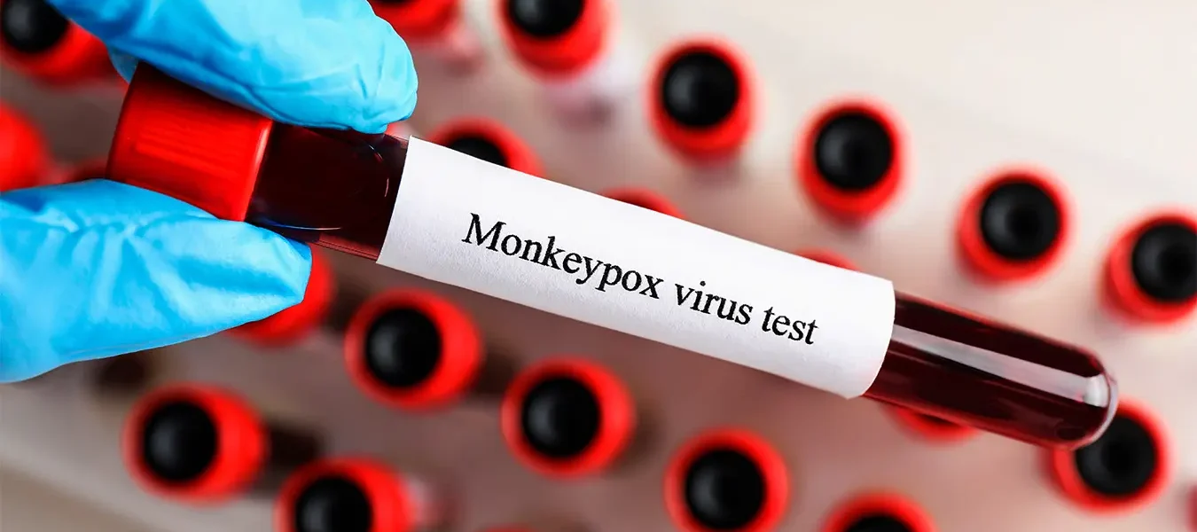 La viruela del mono: una perspectiva histórica y su relevancia actual